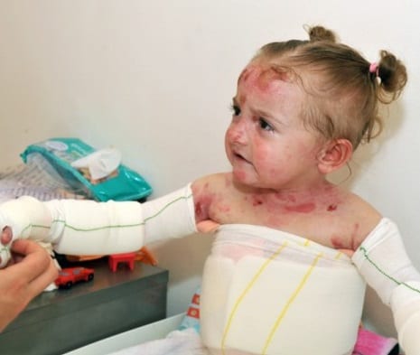 Small child with blisters and sores on face and neck, also covered in bandages across their arms and chest