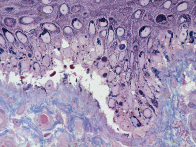 cross section of skin showing blister